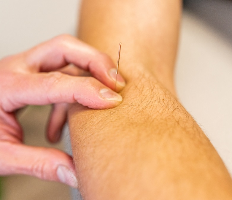 fysio deventer Dry needling